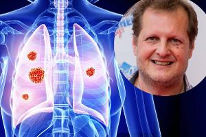 Lungenkrebs – Risikofaktoren, Symptome und Behandlung FLS-TDT
