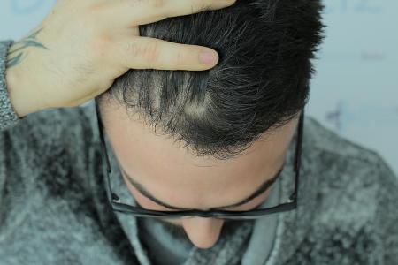 Das Ergebnis einer erfolgreichen Haartransplantation