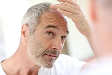 Senior man and hair loss issue model released Symbolfoto PUB...