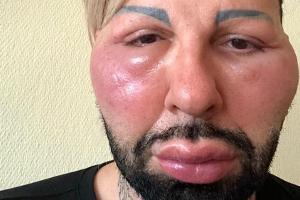Allergie-Schock! So geht es Harald Glööckler jetzt