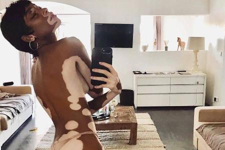 (Fast) nackt und einzigartig: Topmodel Winnie Harlow