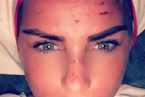 Wer schön sein will, muss leiden: Katie Price blutet aus der Stirn