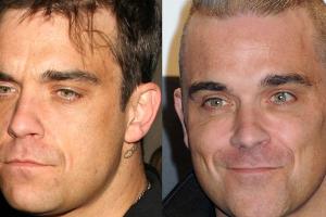 Robbie Williams: Mit Botox holt er sich seine Jugend zurück