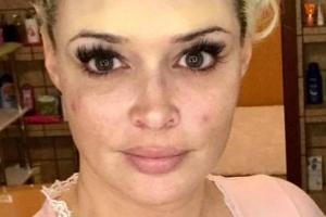 Daniela Katzenberger postet Pickel-Selfies und die Fans lieben es