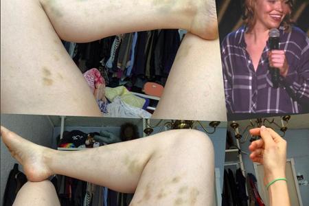 Beth Stellings Beine sind übersät von blauen Flecken Beth Stellings Beine sind übersät von blauen Flecken