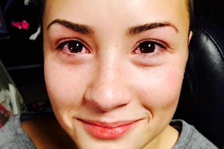Demi Lovato leidet unter einer Katzenallergie Demi Lovato leidet unter einer Katzenallergie