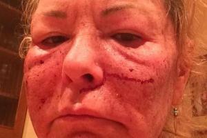 "Rauferei mit Bill Cosby": Roseanne Barr schockt mit blutunterlaufenem Gesicht