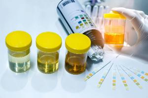 Das sagt die Urinfarbe über die Gesundheit aus