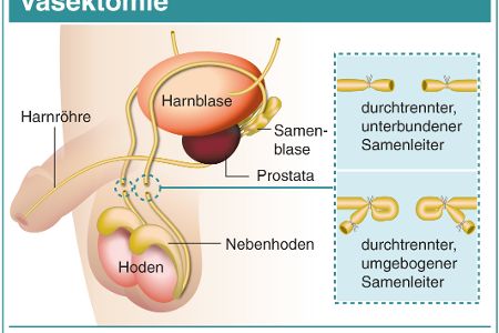 Grafik Vasektomie