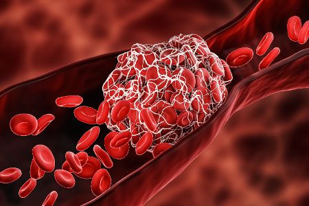 mikrothrombose