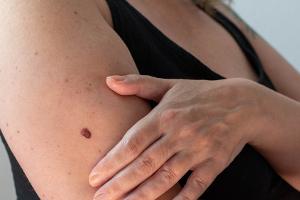 Das ABCDE-Schema: So lässt sich Hautkrebs frühzeitig erkennen