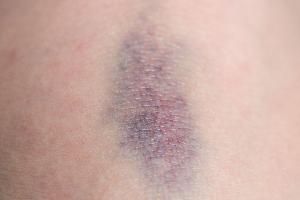 Große blaue Flecken? Dahinter kann eine Erkrankung stecken
