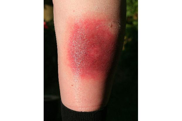 Klares Warnzeichen für Borreliose: Die sogenannte Wanderröte kann Tage oder Wochen nach einem Zeckenstich auftreten.