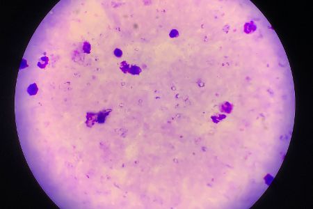 Malaria-Parasiten unter dem Mikroskop