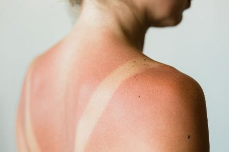 Sonnenbrand vermeiden!