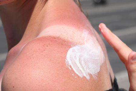 Knallrot und mit Blasen: Was hilft bei starkem Sonnenbrand?