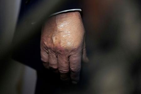 Nachdem der Bluterguss am Handrücken für Aufsehen sorgte, wurde er häufig bei Auftritten zugeschminkt. (Archivbild) Nachdem der Bluterguss am Handrücken für Aufsehen sorgte, wurde er häufig bei Auftritten zugeschminkt. (Archivbild)